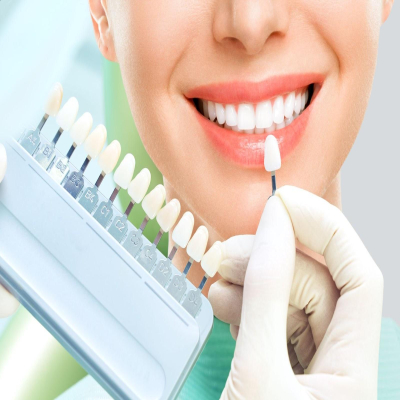 dental-veneers